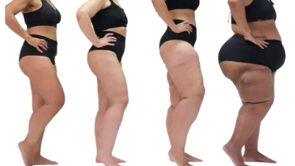 9 Consejos Caseros para el Lipedema: Cómo Controlar los Síntomas